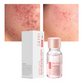 📢📢Buy 1 Get 1 Free!! 🎉Salicylic Acid Spot Drying Lotion